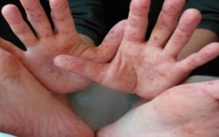 Reforzar medidas de higiene, importante para prevenir coxsackie