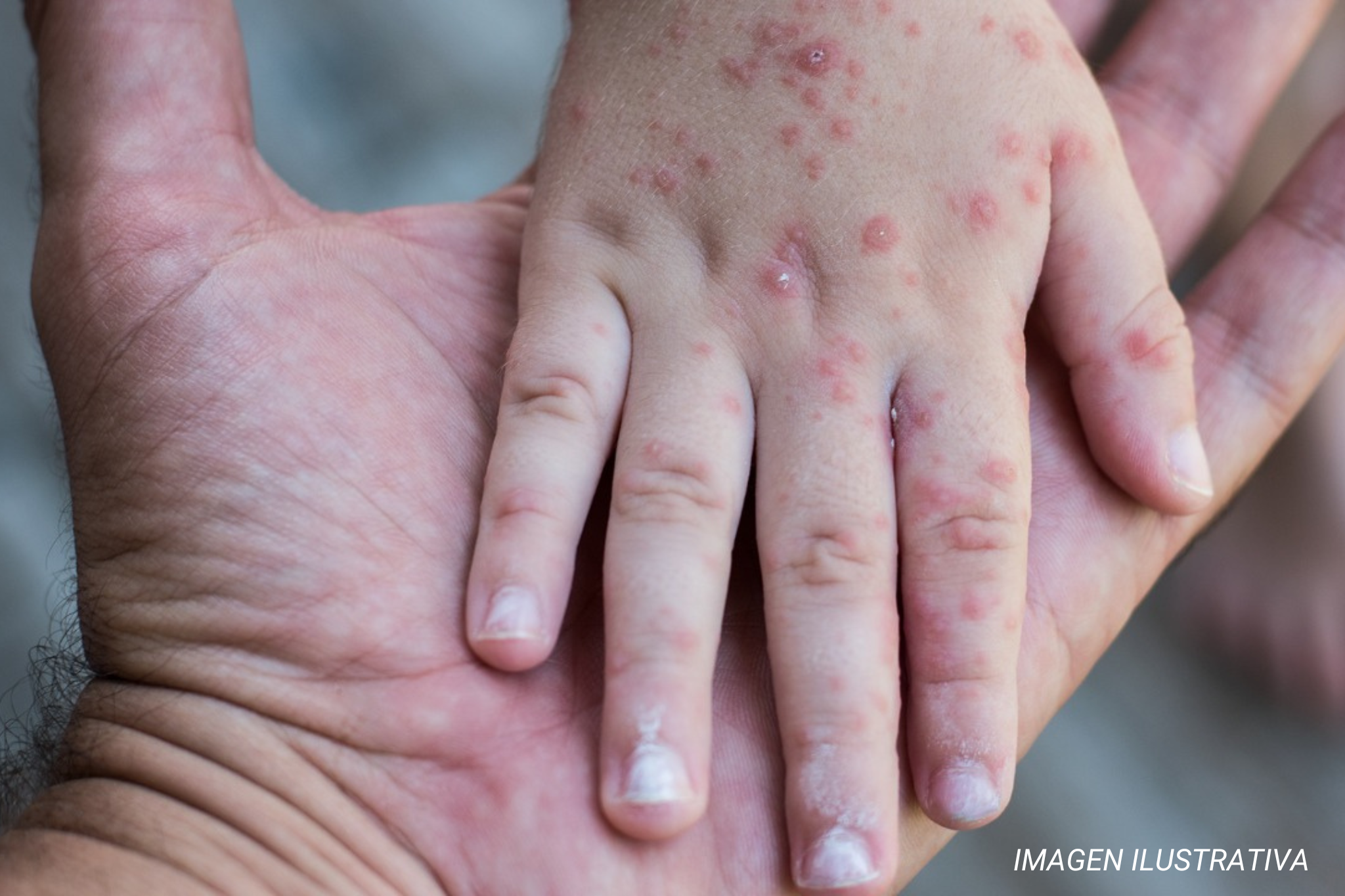Autoridades de salud descartan alerta por virus Coxsackie en Oaxaca